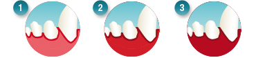 Tandvleesontstekingen herkennen